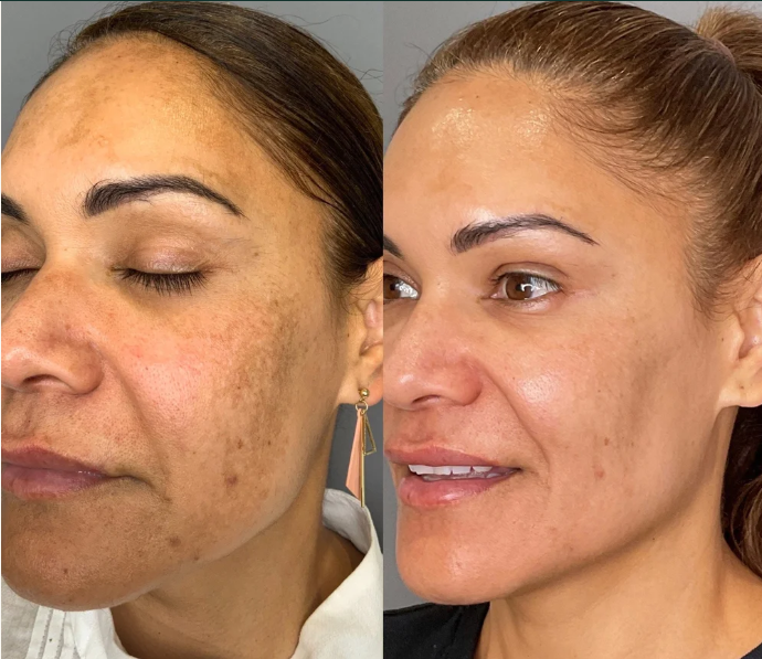 Tratamento Regenerativo de Melasma